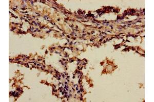 Immunohistochemistry of paraffin-embedded human lung cancer using ABIN7143652 at dilution of 1:100 (ADH7 antibody  (AA 1-386))