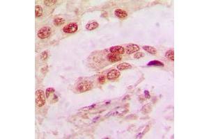 Immunohistochemical analysis of Annexin A1 staining in human lung cancer formalin fixed paraffin embedded tissue section. (Annexin a1 antibody  (Center))