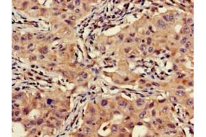 Immunohistochemistry of paraffin-embedded human lung cancer using ABIN7175463 at dilution of 1:100 (VTI1A antibody  (AA 1-175))
