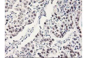 Immunohistochemical staining of paraffin-embedded Carcinoma of Human lung tissue using anti-RBBP7 mouse monoclonal antibody.
