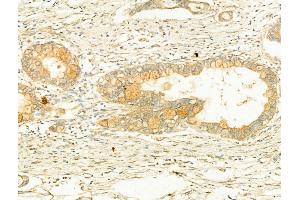 ABIN6265394 and ABIN6266638 at 1/100 staining Human normal tissues adjacent to pancreatic cancer by IHC-P. (Synaptophysin antibody  (Internal Region))