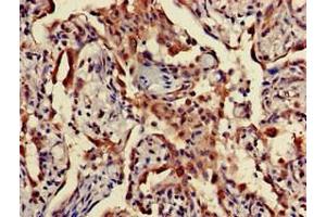 Immunohistochemistry of paraffin-embedded human lung cancer using ABIN7166452 at dilution of 1:100 (TPST1 antibody  (AA 283-370))