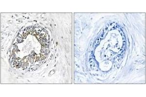 Immunohistochemistry analysis of paraffin-embedded human breast carcinoma tissue, using PAK1/2 (Ab-199) Antibody. (PAK1/2 antibody  (AA 165-214))