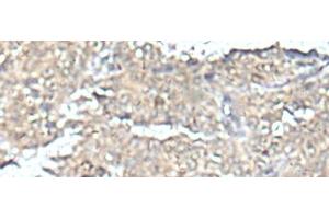 Immunohistochemistry of paraffin-embedded Human ovarian cancer tissue using MEF2D Polyclonal Antibody at dilution of 1:50(x200) (MEF2D antibody)