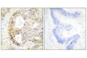Immunohistochemistry analysis of paraffin-embedded human colon carcinoma tissue using COX41 antibody. (COX IV antibody  (N-Term))