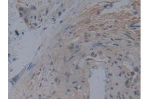 Detection of NOG in Human Pancreatic cancer Tissue using Monoclonal Antibody to Noggin (NOG) (NOG antibody  (AA 28-232))