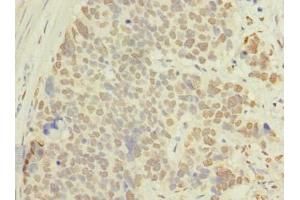 Immunohistochemistry of paraffin-embedded human gastric cancer using ABIN7143116 at dilution of 1:100 (ACTRT1 antibody  (AA 201-376))