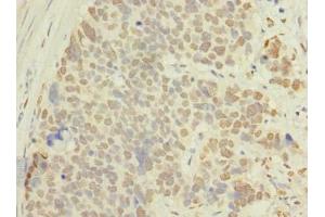 Immunohistochemistry of paraffin-embedded human gastric cancer using ABIN7143116 at dilution of 1:100