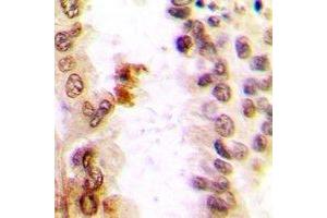 Immunohistochemical analysis of c-Jun staining in human lung cancer formalin fixed paraffin embedded tissue section. (C-JUN antibody)