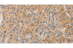 Immunohistochemistry of paraffin-embedded Human liver cancer using NFE2L1 Polyclonal Antibody at dilution of 1:30 (NFE2L1 antibody)