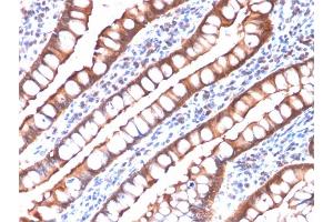 Formalin-fixed, paraffin-embedded human Small Intestinal Carcinoma stained with Villin-Monospecific Recombinant Mouse Monoclonal Antibody (rVIL1/1325). (Recombinant Villin 1 antibody  (AA 179-311))