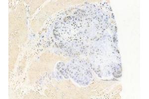 ABIN6264373 and ABIN6277684 at 1/100 staining human gastric carcinoma by IHC-P.