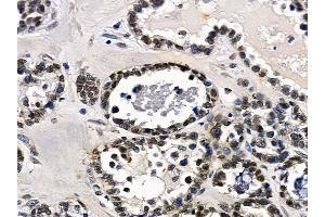 ABIN7097182 and ABIN7101250 at 1/100 staining human ovarian cancer by IHC-P. (FAM122B antibody)