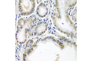 Immunohistochemistry of paraffin-embedded human colon carcinoma using SSX2 antibody at dilution of 1:200 (40x lens). (SSX2 antibody)