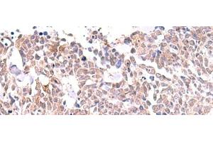 Immunohistochemistry of paraffin-embedded Human lung cancer tissue using INPP5K Polyclonal Antibody at dilution of 1:85(x200) (INPP5K antibody)