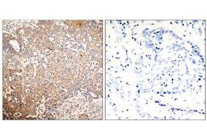 Immunohistochemical analysis of paraffin-embedded human breast carcinoma tissue using Keratin 18 (Phospho-Ser33) antibody (E011306). (Cytokeratin 18 antibody  (pSer33))