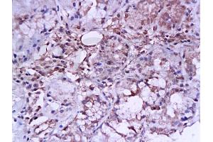 Formalin-fixed and paraffin embedded human laryngeal carcinoma labeled with Anti-ER-alpha Polyclonal Antibody, unconjugated  (ABIN726890)  at 1: 200 followed by incubation with conjugated secondary antibody and DAB staining (Estrogen Receptor alpha antibody  (AA 501-595))