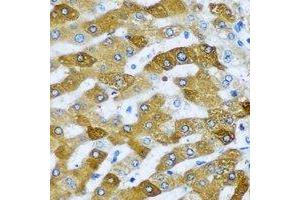 Immunohistochemical analysis of Tim17 staining in human liver cancer formalin fixed paraffin embedded tissue section. (TIMM17A antibody)