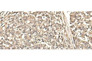 Immunohistochemistry of paraffin-embedded Human esophagus cancer tissue using BUD31 Polyclonal Antibody at dilution of 1:75(x200) (BUD31 antibody)