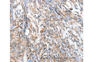 Immunohistochemistry of Human esophagus cancer using APOBEC3D Polyclonal Antibody at dilution of 1:80