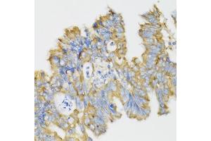 Immunohistochemistry of paraffin-embedded human rectal cancer using GHRL antibody (ABIN6131231, ABIN6141079, ABIN6141080 and ABIN6216264) at dilution of 1:100 (40x lens). (Ghrelin antibody  (AA 1-117))