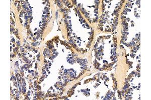 ABIN7095873 and ABIN7099935 at 1/100 staining human ovarian cancer by IHC-P. (C1orf151 antibody)