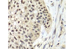 Immunohistochemistry of paraffin-embedded Human lung cancer using RFC5 Polyclonal Antibody at dilution of 1:100 (40x lens). (RFC5 antibody)