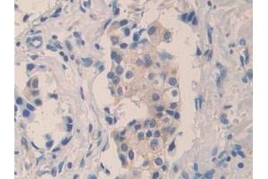 Detection of F5 in Human Breast cancer Tissue using Polyclonal Antibody to Coagulation Factor V (F5) (Coagulation Factor V antibody  (AA 1979-2217))