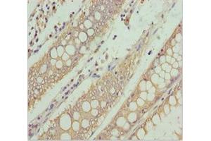 Immunohistochemistry of paraffin-embedded human colon cancer using ABIN7169114 at dilution of 1:100 (NEK8 antibody  (AA 1-300))