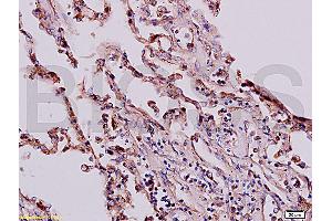 Formalin-fixed and paraffin embedded human lung labeled with Anti-Beta-HCG/HCG beta Polyclonal Antibody, Unconjugated (ABIN730243) at 1:200, followed by conjugation to the secondary antibody and DAB staining (HCG beta antibody  (AA 81-165))