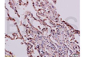 Formalin-fixed and paraffin embedded human lung labeled with Anti-Beta-HCG/HCG beta Polyclonal Antibody, Unconjugated (ABIN730243) at 1:200, followed by conjugation to the secondary antibody and DAB staining