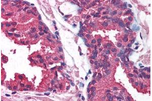 Human Prostate (formalin-fixed, paraffin-embedded) stained with AKT1 antibody ABIN214085 at 5 ug/ml followed by biotinylated goat anti-rabbit IgG secondary antibody ABIN481713, alkaline phosphatase-streptavidin and chromogen. (AKT1 antibody  (AA 121-170))