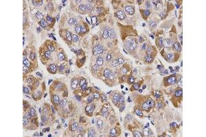 Immunohistochemistry of paraffin-embedded Human liver cancer using UGT1A9 Polyclonal Antibody at dilution of 1:200 (40x lens). (UGT1A9 antibody)