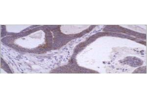 Immunohistochemical staining using MMP-1 antibody  on colon carcinoma tissue section. (MMP1 antibody  (C-Term))