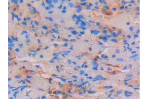 DAB staining on IHC-P; Samples: Human Lung Tissue (STAT4 antibody  (AA 505-737))