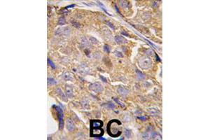 Formalin-fixed and paraffin-embedded human breast carcinoma tissue reacted with EIF4B polyclonal antibody  , which was peroxidase-conjugated to the secondary antibody, followed by DAB staining.