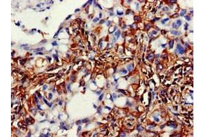 Immunohistochemistry of paraffin-embedded human lung cancer using ABIN7169541 at dilution of 1:100