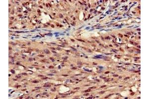 Immunohistochemistry of paraffin-embedded human lung cancer using ABIN7170803 at dilution of 1:100 (STOML3 antibody  (AA 205-291))