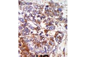 Formalin-fixed and paraffin-embedded human cancer tissue reacted with the primary antibody, which was peroxidase-conjugated to the secondary antibody, followed by AEC staining. (PRKG1 antibody  (C-Term))