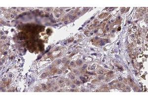 ABIN6277418 at 1/100 staining Human liver cancer tissue by IHC-P. (P2RY4 antibody  (C-Term))