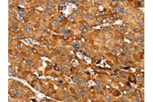 The image on the left is immunohistochemistry of paraffin-embedded Human liver cancer tissue using ABIN7130896(RNF14 Antibody) at dilution 1/20, on the right is treated with fusion protein. (RNF14 antibody)