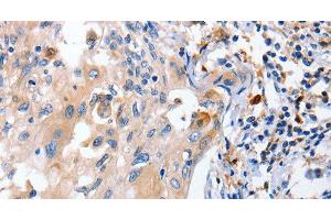 Immunohistochemistry of paraffin-embedded Human cervical cancer using IL18 Polyclonal Antibody at dilution of 1:100