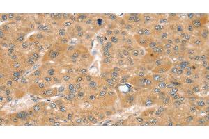 Immunohistochemistry of paraffin-embedded Human liver cancer using SNX2 Polyclonal Antibody at dilution of 1:40 (Sorting Nexin 2 antibody)