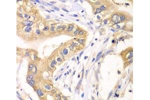 Immunohistochemistry of paraffin-embedded Human liver cancer using HAGH Polyclonal Antibody at dilution of 1:100 (40x lens).