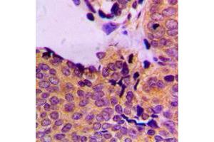 Immunohistochemical analysis of PDPK1 (pS241) staining in human breast cancer formalin fixed paraffin embedded tissue section.