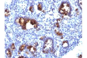 Formalin-fixed, paraffin-embedded human Gastric Carcinoma stained with MUC3 Monoclonal Antibody (MUC3/1154). (MUC3A antibody)