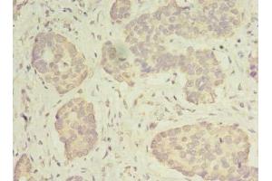Immunohistochemistry of paraffin-embedded human gastric cancer using ABIN7142267 at dilution of 1:100 (MRPS31 antibody  (AA 66-395))