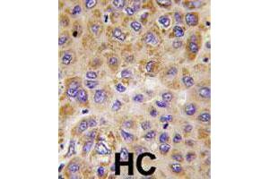 Formalin-fixed and paraffin-embedded human hepatocellular carcinoma reacted with PFKFB1 polyclonal antibody  , which was peroxidase-conjugated to the secondary antibody, followed by DAB staining. (PFKFB1 antibody  (Internal Region))