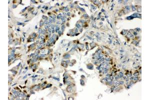 Anti- BMP5 Picoband antibody, IHC(P) IHC(P): Human Lung Cancer Tissue (BMP5 antibody  (C-Term))