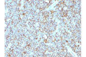 Formalin-fixed, paraffin-embedded human Ewing's Sarcoma stained with CD99 Rabbit Recombinant Monoclonal Antibody (MIC2/1495R). (Recombinant CD99 antibody)